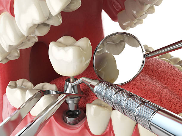 Best Emergency Dentist for Lost Fillings or Crowns in Ludowici, GA